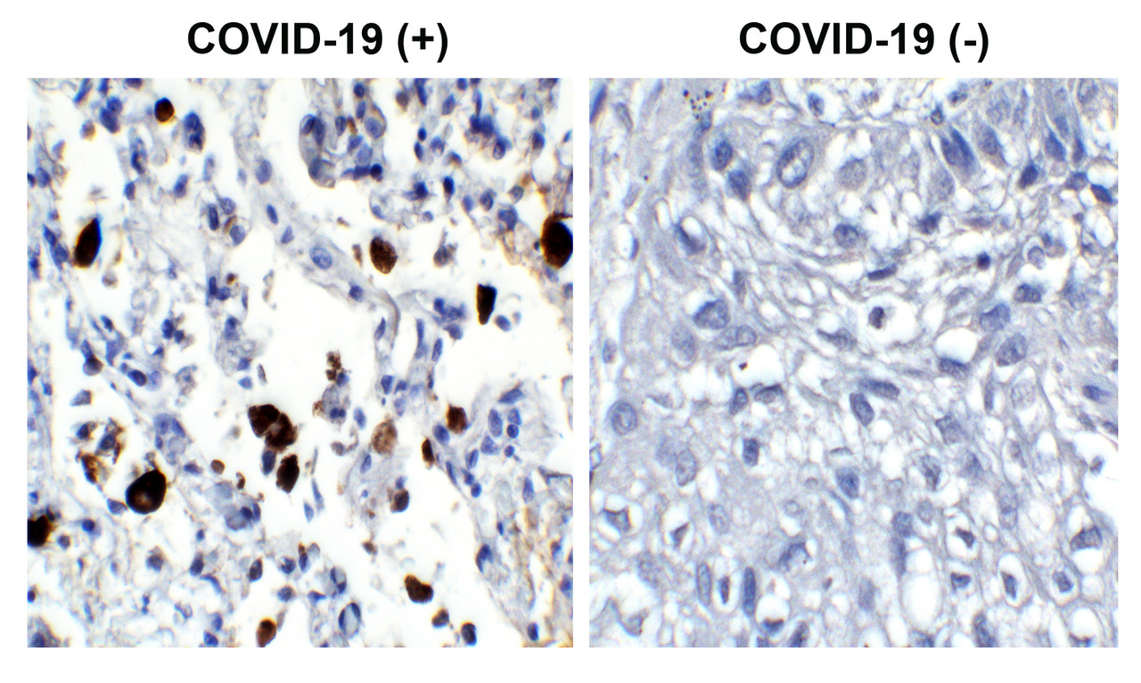 <strong>Figure 1 Immunohistochemistry Validation of SARS-CoV-2 (COVID-19) Nucleocapsid in COVID-19 Patient Lung</strong><br> 
Immunohistochemical analysis of paraffin-embedded COVID-19 patient lung tissue using anti- SARS-CoV-2 (COVID-19) Nucleocapsid antibody (35-720, 1 ug/mL) . Tissue was fixed with formaldehyde and blocked with 10% serum for 1 h at RT; antigen retrieval was by heat mediation with a citrate buffer (pH6) . Samples were incubated with primary antibody overnight at 4&#730;C. A goat anti-rabbit IgG H&L (HRP) at 1/250 was used as secondary. Counter stained with Hematoxylin. Strong signal of SARS-COV-2 Nucleocapsid protein was observed in the macrophages of COVID-19 patient lung, but not in non-COVID-19 patient lung.