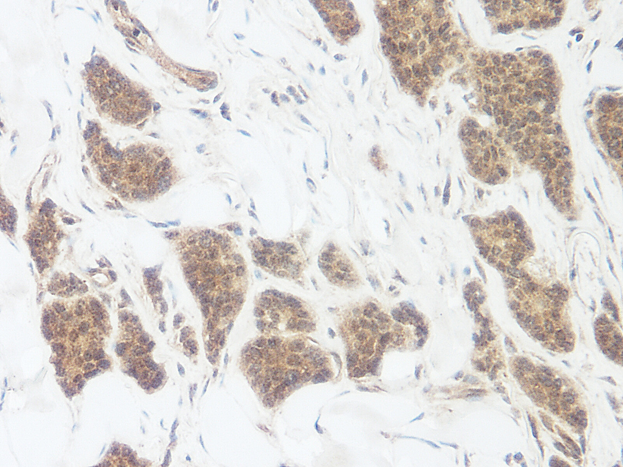 This antibody stained formalin-fixed, paraffin-embedded sections of human breast invasive ductal carcinoma. The recommended concentration is 0.125 ug/ml - 0.25 ug/ml with an overnight incubation at 4&#730;C. An HRP-labeled polymer detection system was used with a DAB chromogen. Heat induced antigen retrieval with a pH 6.0 sodium citrate buffer is recommended. Optimal concentrations and conditions may vary.