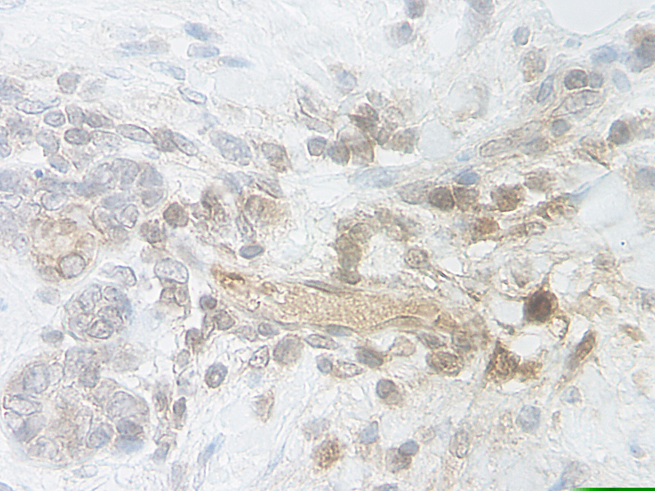 This antibody stained formalin-fixed, paraffin-embedded sections of human breast malignant carcinoma. The recommended concentration is 5.0 ug/ml with an overnight incubation at 4˚C. An HRP-labeled polymer detection system was used with a DAB chromogen. Heat induced antigen retrieval with a pH 9.0 buffer is recommended. See photo (s) . Optimal concentrations and conditions may vary.