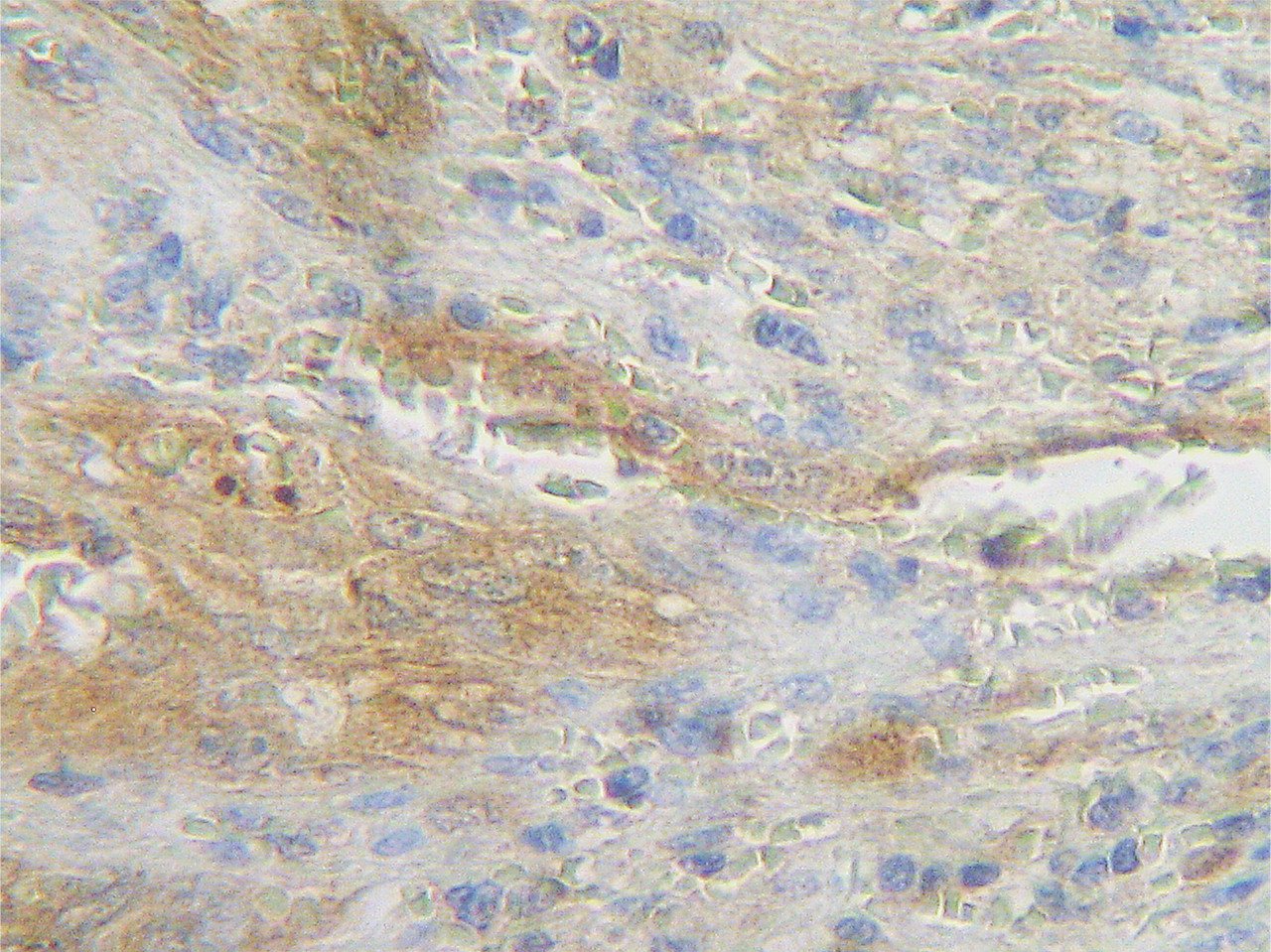 This antibody stained formalin-fixed, paraffin-embedded sections of human angiosarcoma. The recommended concentration is 0.75 ug/mL - 2.5 ug/mL with an overnight incubation at 4&#730;C. An HRP-labeled polymer detection system was used with a AB chromogen. Heat induced antigen retrieval with a pH 6.0 sodium citrate buffer is recommended. Optimal concentrations and conditions may vary.