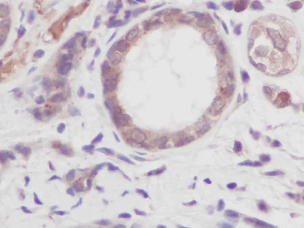 This antibody stained formalin-fixed, paraffin-embedded sections of human breast invasive ductal carcinoma. The recommended concentrations are 0.5 ug/ml-1.0 ug/ml with an overnight incubation at 4&#730;C. An HRP-labeled polymer detection system was used with a DAB chromogen. Heat induced antigen retrieval with a pH 6.0 Sodium Citrate buffer is recommended. Optimal concentrations and conditions may vary.