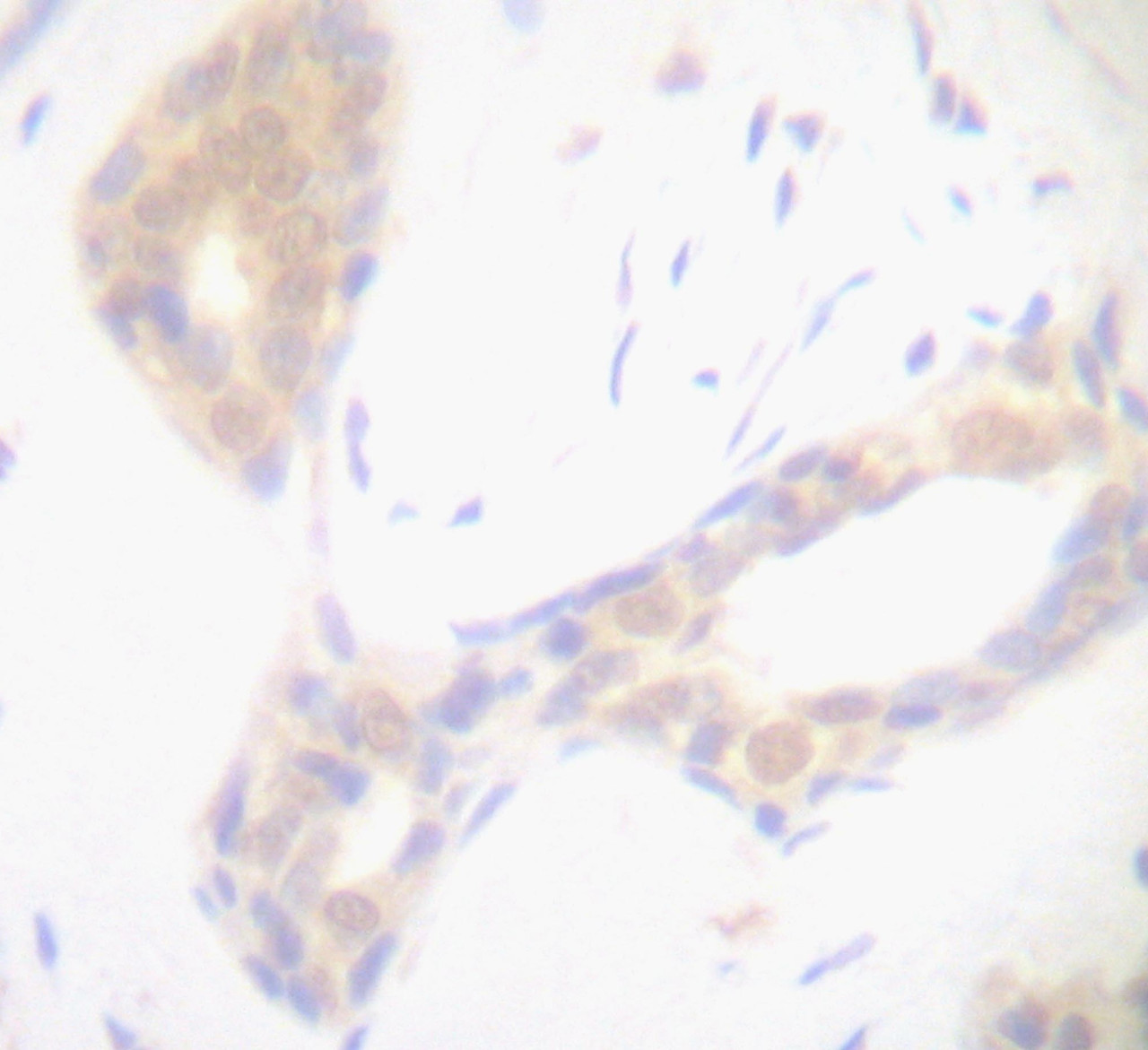 This antibody stained formalin-fixed, paraffin-embedded sections of human breast invasive ductal carcinoma. The recommended concentrations are 2.5 ug/ml-5.0 ug/ml with a two-hour incubation at room temperature or an overnight incubation at 4&#730;C. An HRP-labeled polymer detection system was used with a DAB chromogen. This antibody was also tested in an HRP-biotin labeling detection system. Heat induced antigen retrieval with a pH 6.0 Sodium Citrate buffer is recommended. Optimal concentrations and conditions may vary.