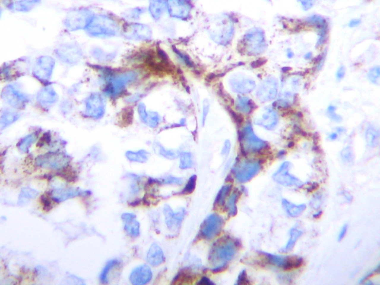 This antibody stained formalin-fixed, paraffin-embedded sections of human breast invasive ductal carcinoma. The recommended concentrations are 0.25-0.50 ug/ml overnight at 4˚C. An HRP-labeled polymer detection system was used with DAB chromogen. Heat induced antigen retrieval was performed with a pH 6.0 Sodium Citrate buffer. Optimal concentrations and conditions may vary. Tissue samples were provided by the Cooperative Human Tissue Network which is funded by the National Cancer Institute.