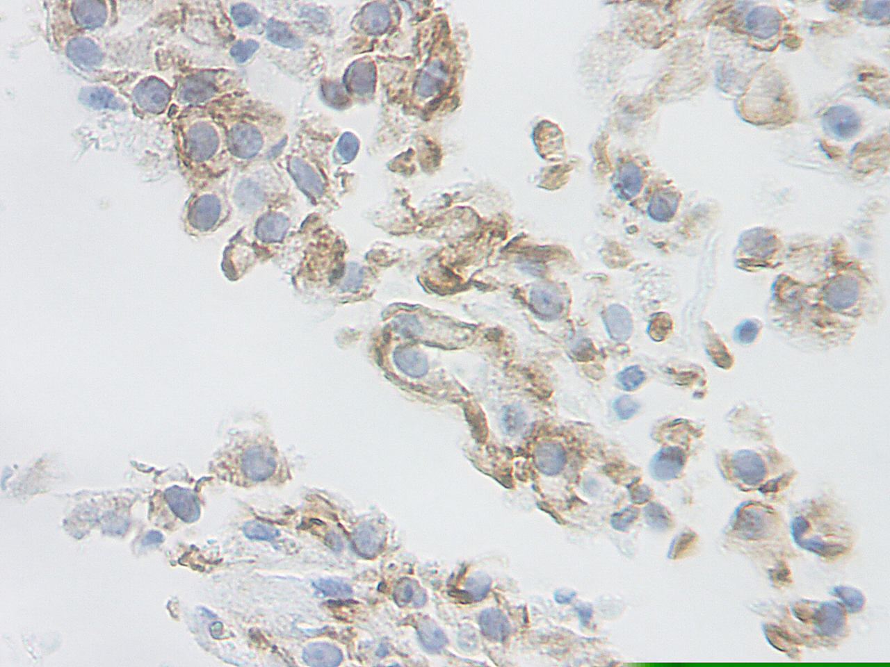 This antibody stained formalin-fixed, paraffin-embedded sections of human renal cell carcinoma. The recommended concentration is 2.5 ug/ml- 1.5 ug/ml with an overnight incubation at 4˚C. An HRP-labeled polymer detection system was used with a DAB chromogen. Heat induced antigen retrieval with a pH 9.0 buffer is recommended. Optimal concentrations and conditions may vary.