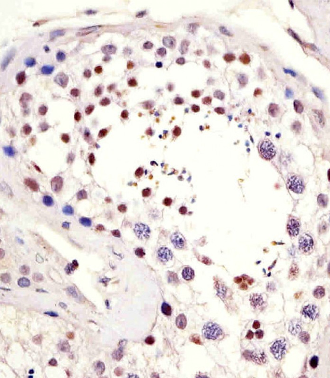 Antibody staining LIN28B in human testis tissue sections by Immunohistochemistry (IHC-P - paraformaldehyde-fixed, paraffin-embedded sections) .