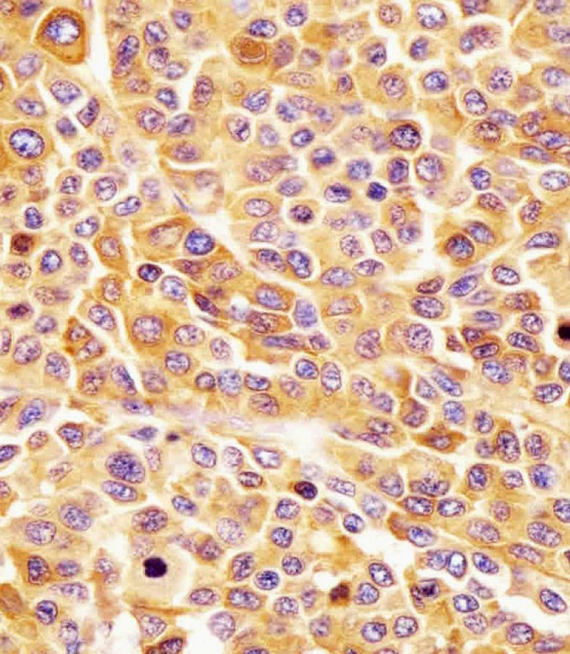 Antibody staining CD63 in human melanoma tissue sections by Immunohistochemistry (IHC-P - paraformaldehyde-fixed, paraffin-embedded sections) .