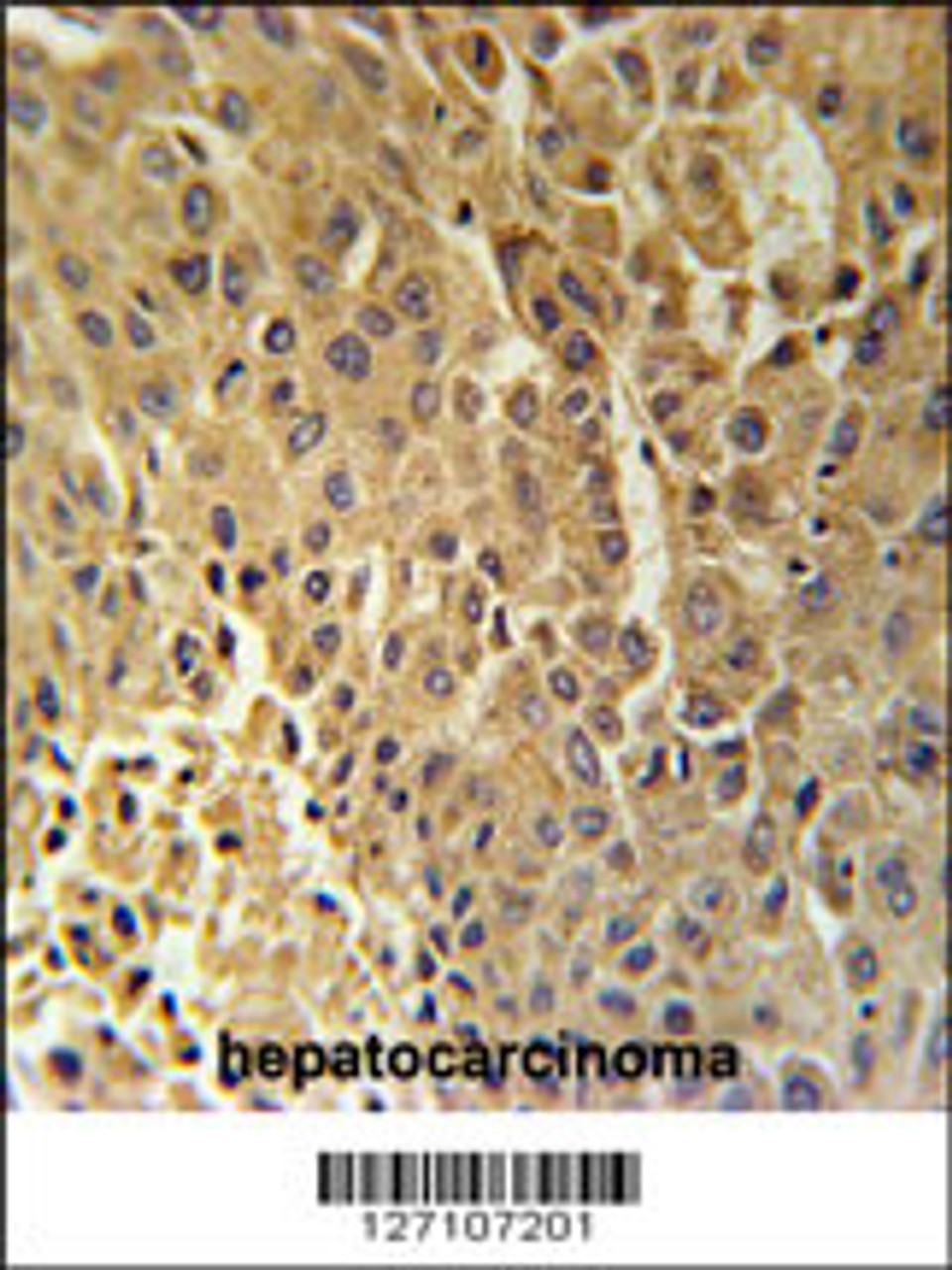 DHB13 Antibody immunohistochemistry analysis in formalin fixed and paraffin embedded human hepatocarcinoma followed by peroxidase conjugation of the secondary antibody and DAB staining.