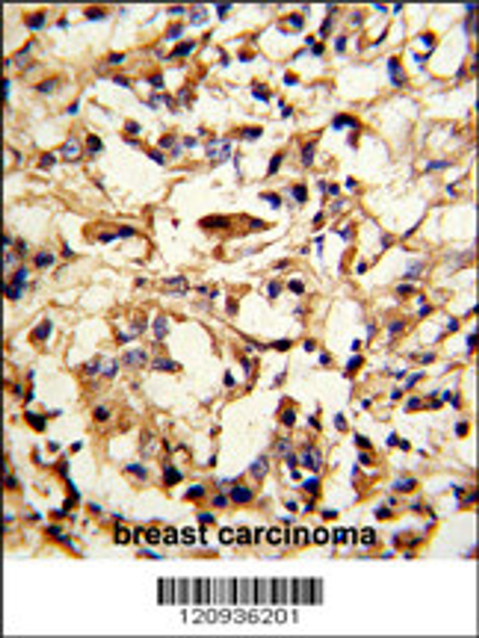 Formalin-fixed and paraffin-embedded human breast carcinoma reacted with DFNA5 Antibody (N-term) , which was peroxidase-conjugated to the secondary antibody, followed by DAB staining.