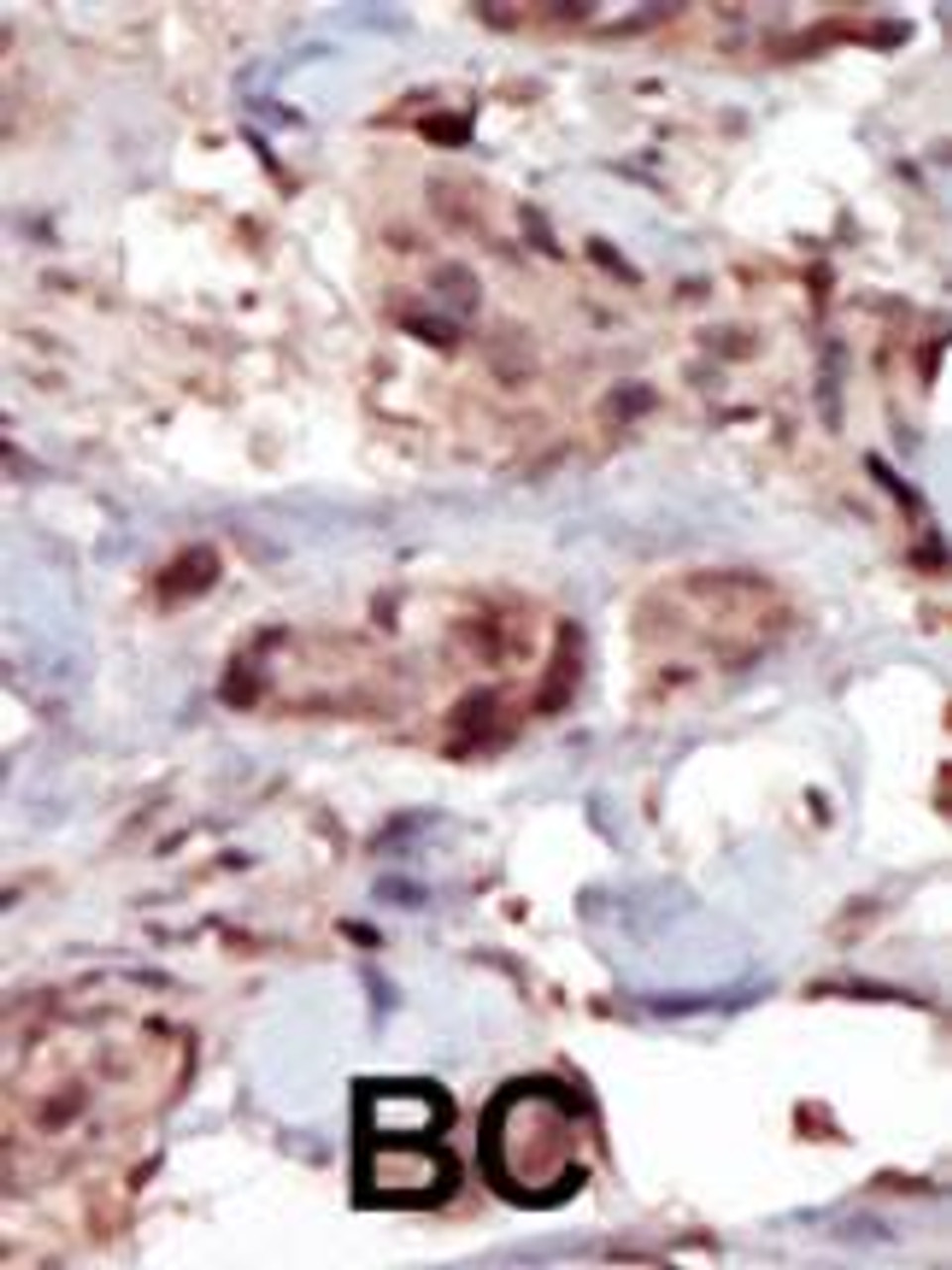 Formalin-fixed and paraffin-embedded human cancer tissue reacted with the primary antibody, which was peroxidase-conjugated to the secondary antibody, followed by AEC staining. BC = breast carcinoma; HC = hepatocarcinoma.