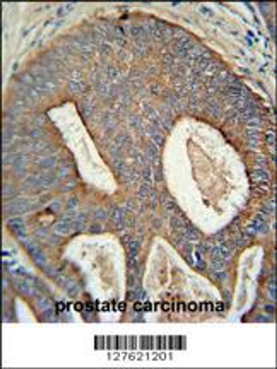 POTEB antibody immunohistochemistry analysis in formalin fixed and paraffin embedded human prostate carcinoma followed by peroxidase conjugation of the secondary antibody and DAB staining.