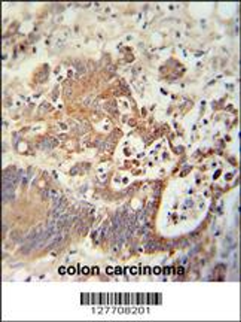 CHCHD2 antibody immunohistochemistry analysis in formalin fixed and paraffin embedded human colon carcinoma followed by peroxidase conjugation of the secondary antibody and DAB staining.