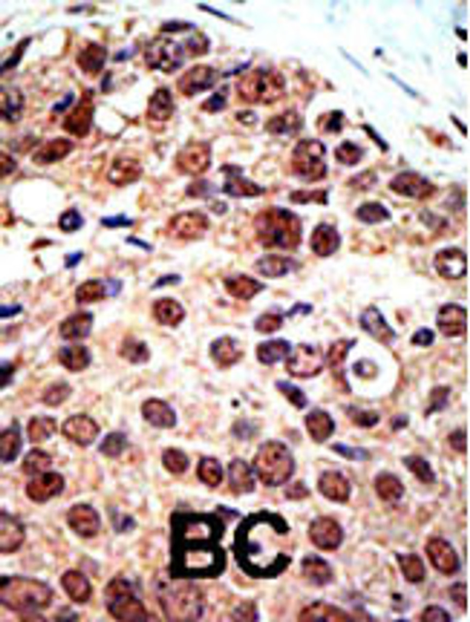 Formalin-fixed and paraffin-embedded human cancer tissue reacted with the primary antibody, which was peroxidase-conjugated to the secondary antibody, followed by DAB staining. BC = breast carcinoma; HC = hepatocarcinoma.