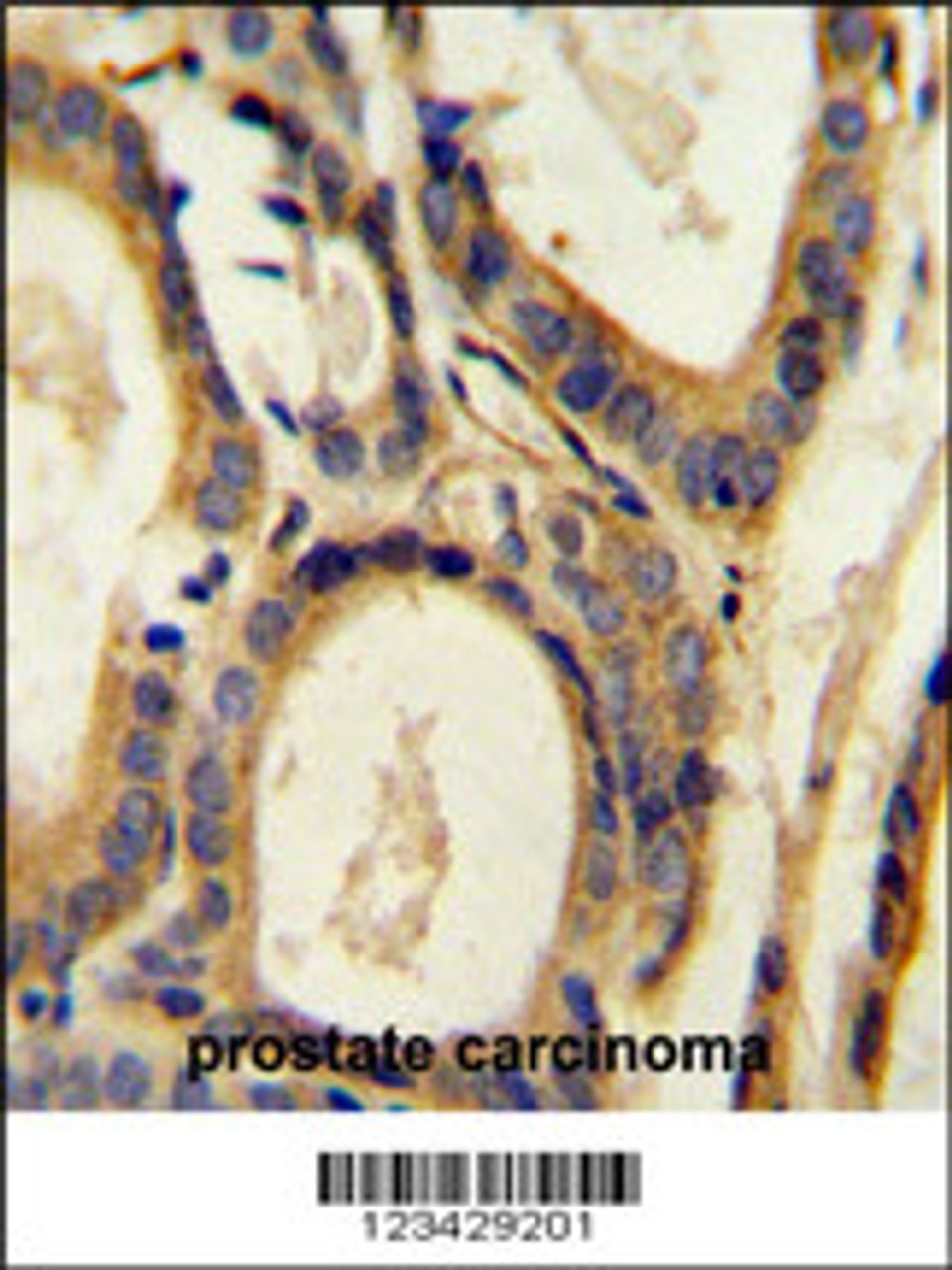 CCL4 Antibody immunohistochemistry analysis in formalin fixed and paraffin embedded human prostate carcinoma followed by peroxidase conjugation of the secondary antibody and DAB staining.