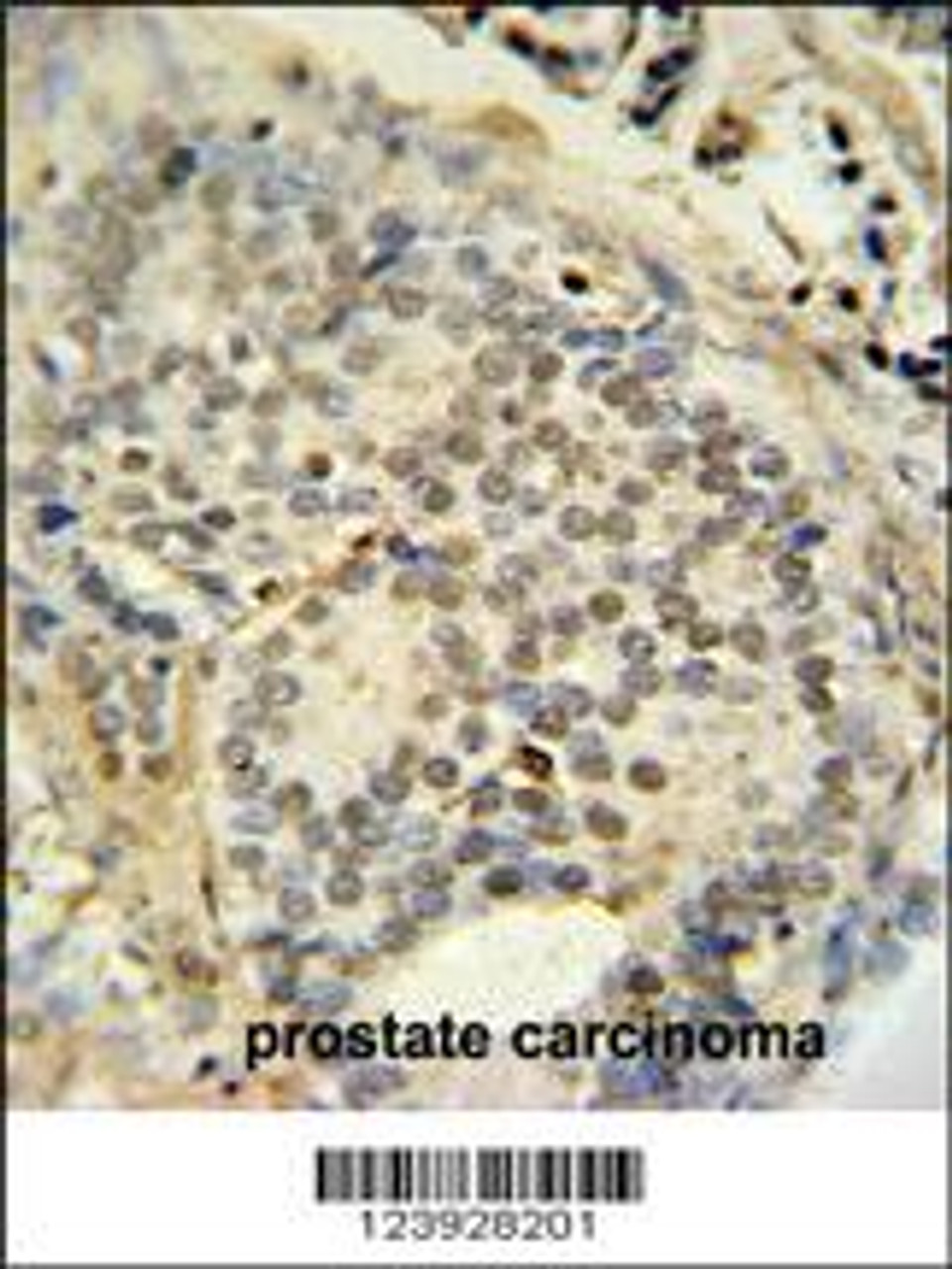 FUS antibody immunohistochemistry analysis in formalin fixed and paraffin embedded human prostate carcinoma followed by peroxidase conjugation of the secondary antibody and DAB staining.