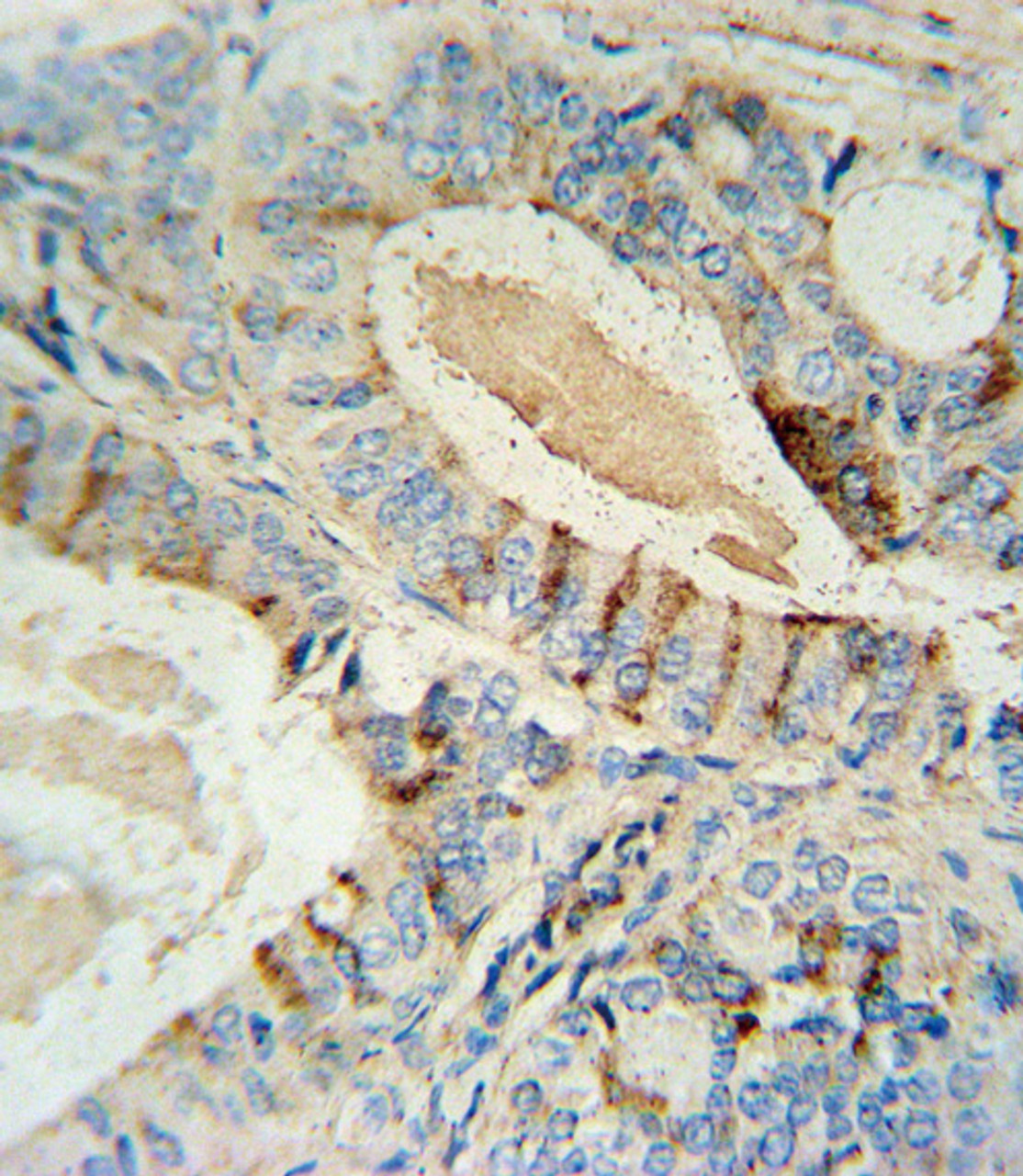 GCNT2 antibody immunohistochemistry analysis in formalin fixed and paraffin embedded human prostate carcinoma followed by peroxidase conjugation of the secondary antibody and DAB staining.