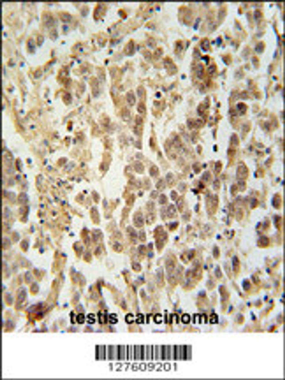 LUZP4 antibodyimmunohistochemistry analysis in formalin fixed and paraffin embedded human testis carcinoma followed by peroxidase conjugation of the secondary antibody and DAB staining. This data demonstrates the use of the LUZP4 antibodyfor immunohistochemistry.