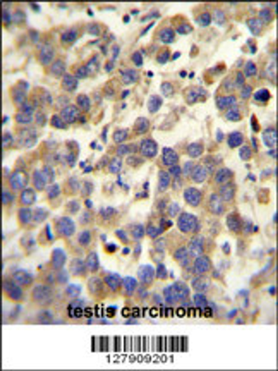 LYPD4 antibody immunohistochemistry analysis in formalin fixed and paraffin embedded human testis carcinoma followed by peroxidase conjugation of the secondary antibody and DAB staining.
