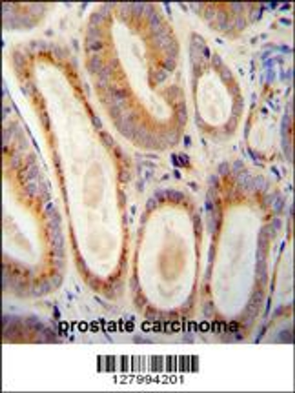 WFDC12 antibody immunohistochemistry analysis in formalin fixed and paraffin embedded human prostate carcinoma followed by peroxidase conjugation of the secondary antibody and DAB staining.
