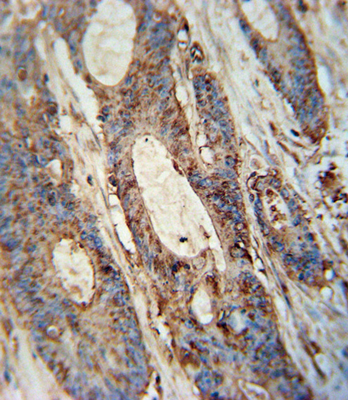 FAM46A antibody immunohistochemistry analysis in formalin fixed and paraffin embedded human colon carcinoma followed by peroxidase conjugation of the secondary antibody and DAB staining.