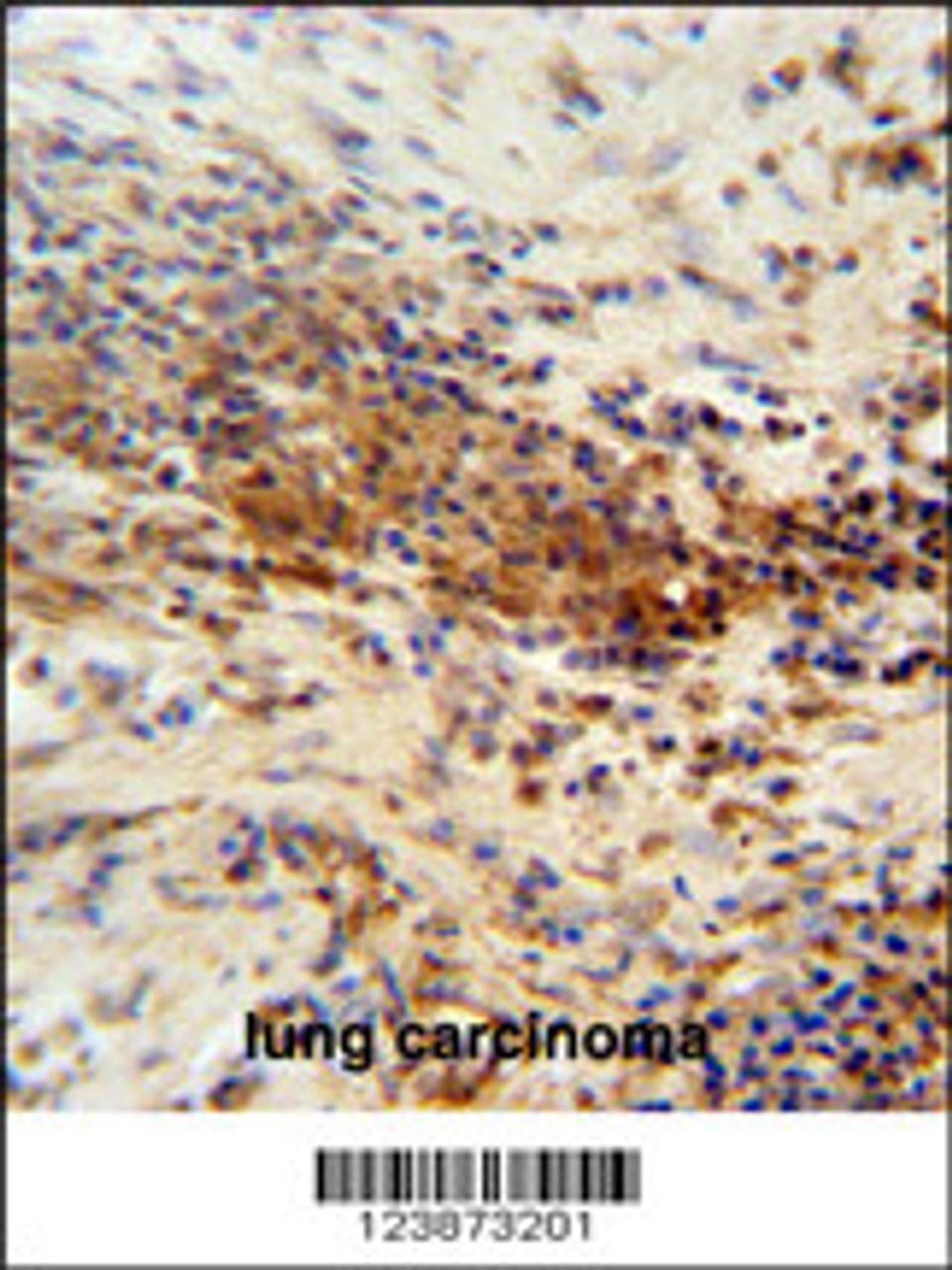 DNAJC11 antibody immunohistochemistry analysis in formalin fixed and paraffin embedded human lung carcinoma followed by peroxidase conjugation of the secondary antibody and DAB staining.