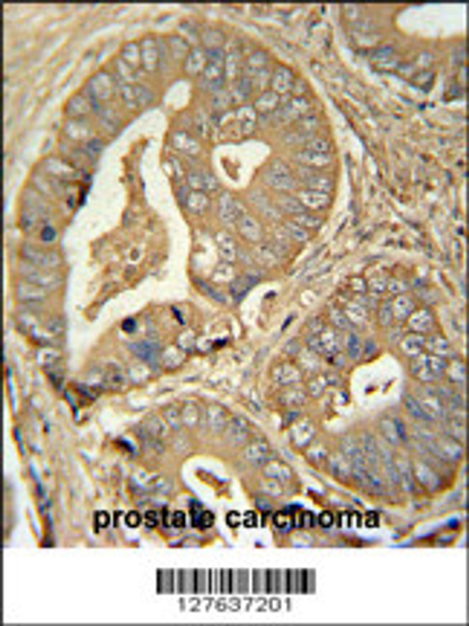 ISCA2 antibody immunohistochemistry analysis in formalin fixed and paraffin embedded human prostate carcinoma followed by peroxidase conjugation of the secondary antibody and DAB staining.