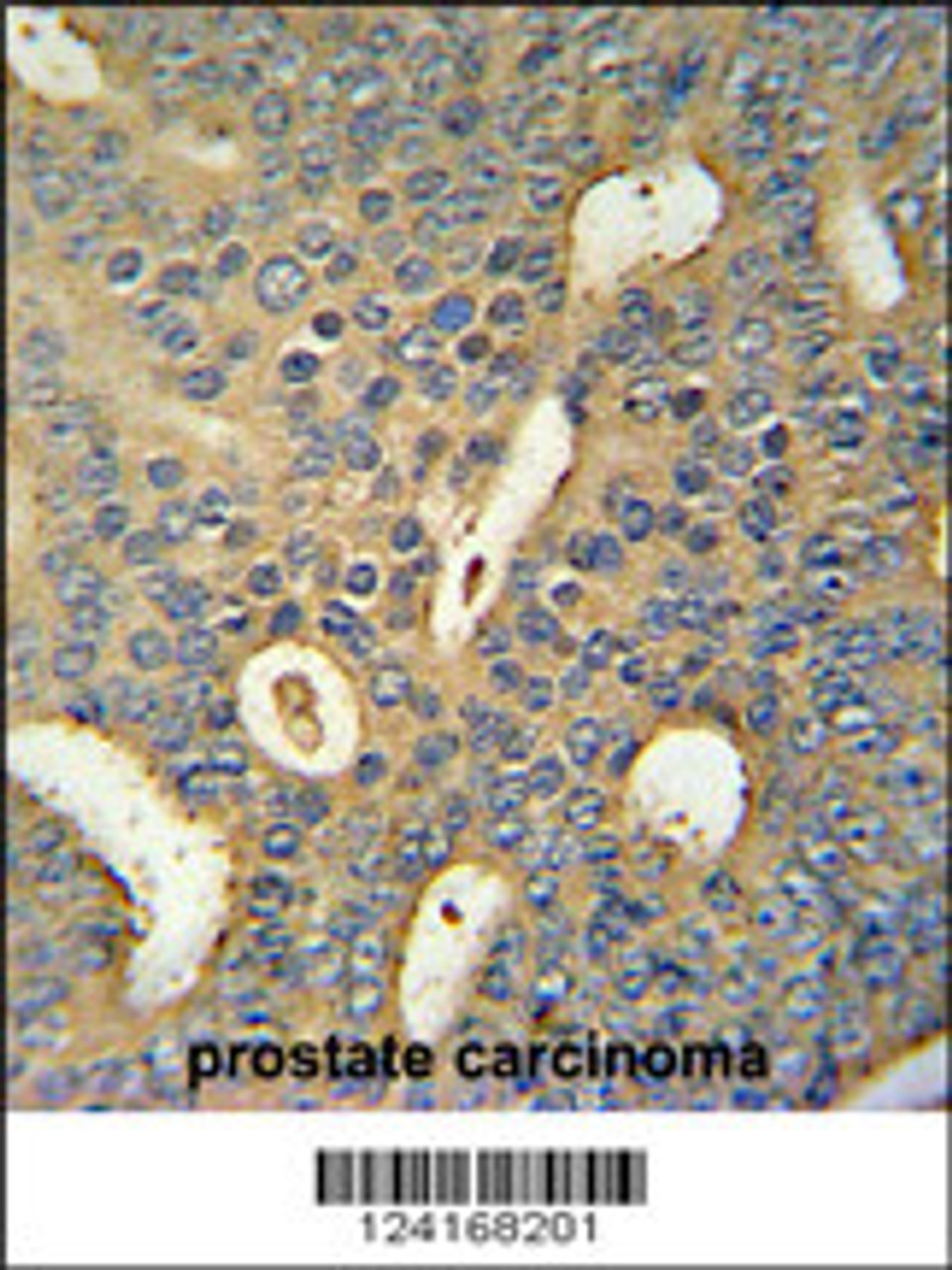 MICALL1 Antibody immunohistochemistry analysis in formalin fixed and paraffin embedded human prostate carcinoma followed by peroxidase conjugation of the secondary antibody and DAB staining.