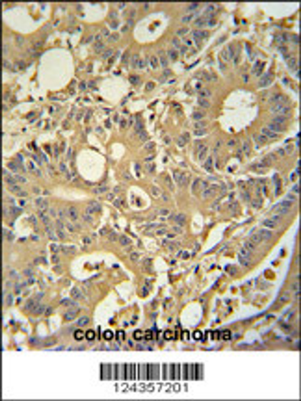 TPSD1 antibody immunohistochemistry analysis in formalin fixed and paraffin embedded human colon carcinoma followed by peroxidase conjugation of the secondary antibody and DAB staining.