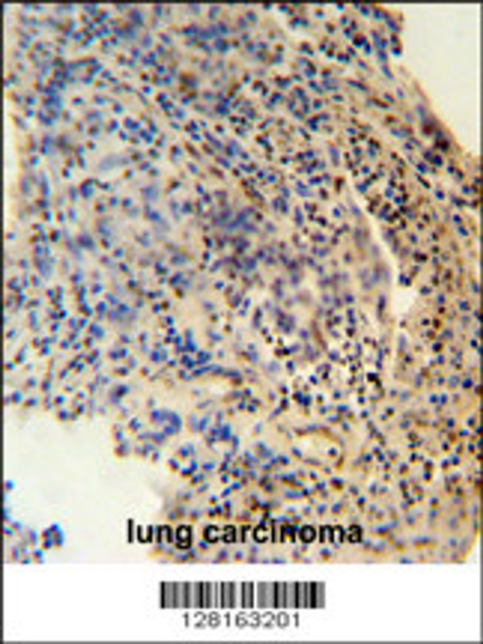 ZNF197 antibody immunohistochemistry analysis in formalin fixed and paraffin embedded human lung carcinoma followed by peroxidase conjugation of the secondary antibody and DAB staining.