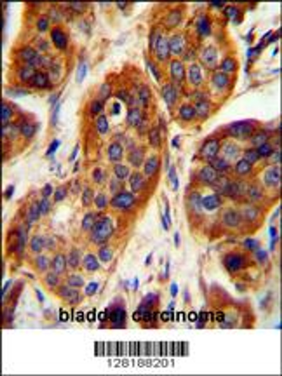 LRRC57 Antibody immunohistochemistry analysis in formalin fixed and paraffin embedded human bladder carcinoma followed by peroxidase conjugation of the secondary antibody and DAB staining.