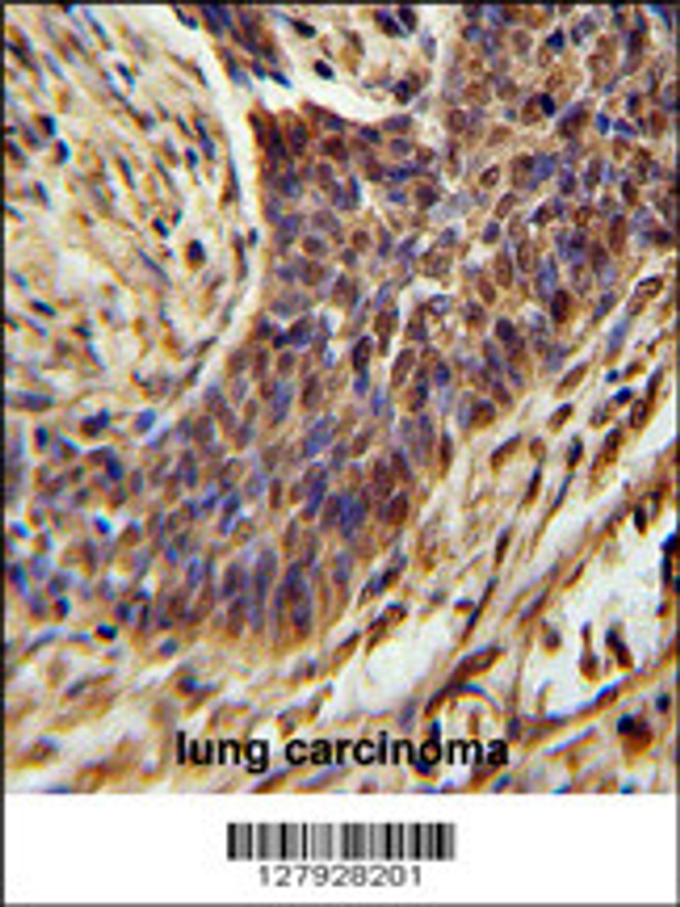 ZSWIM1 Antibody immunohistochemistry analysis in formalin fixed and paraffin embedded human lung carcinoma followed by peroxidase conjugation of the secondary antibody and DAB staining.