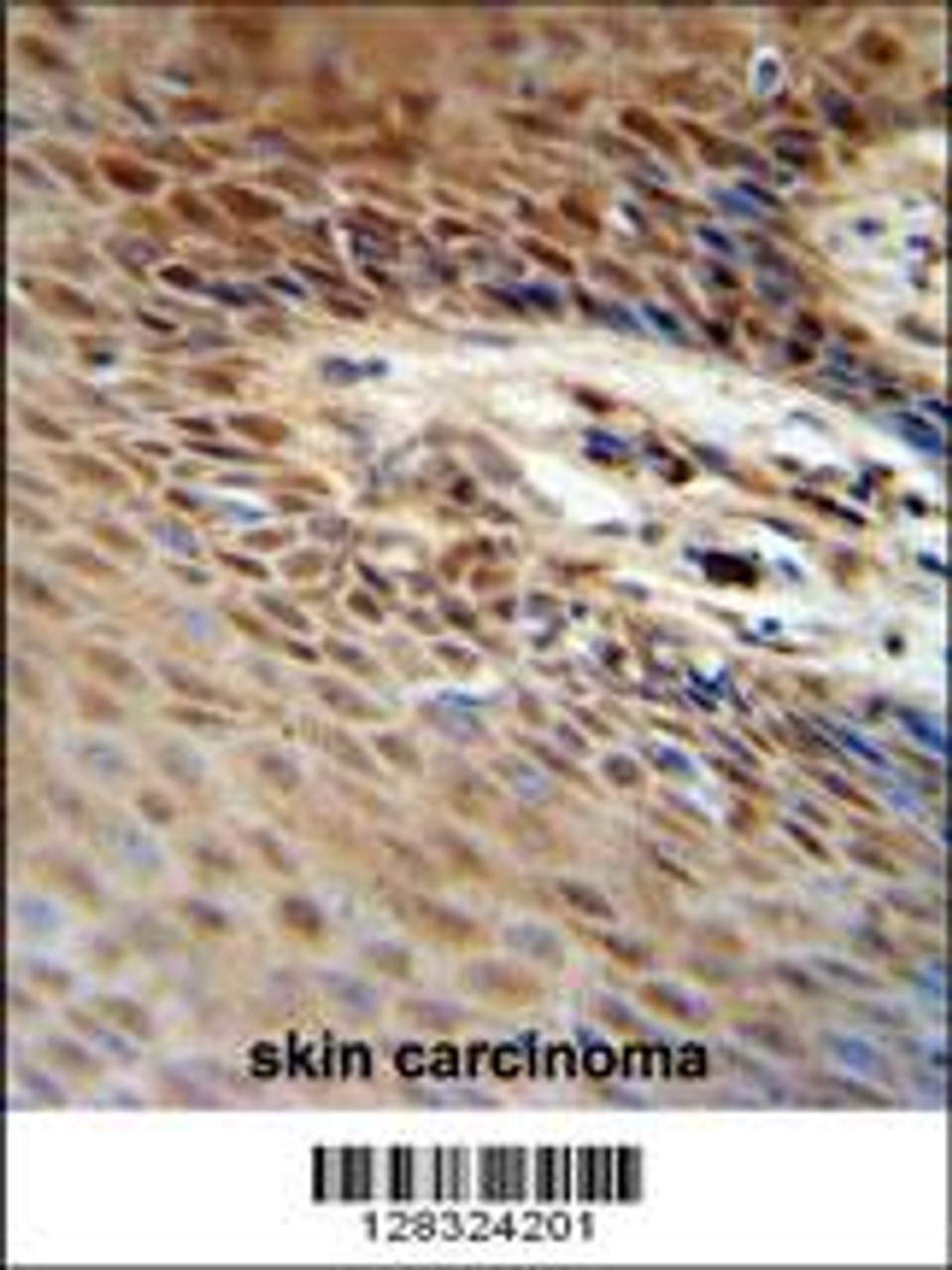 ZNF324B antibody immunohistochemistry analysis in formalin fixed and paraffin embedded human skin carcinoma followed by peroxidase conjugation of the secondary antibody and DAB staining.
