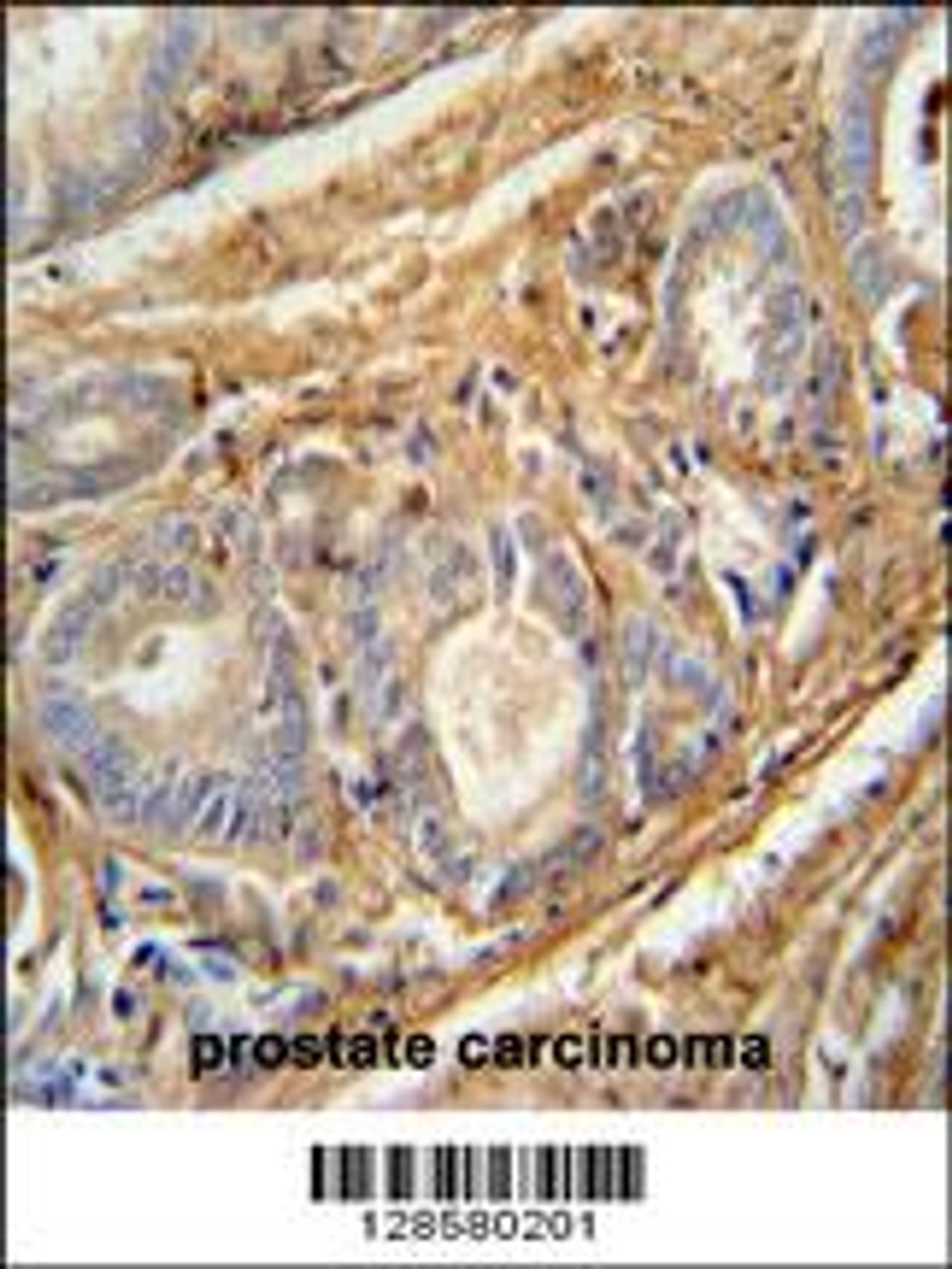 PCOTH antibody immunohistochemistry analysis in formalin fixed and paraffin embedded human prostate carcinoma followed by peroxidase conjugation of the secondary antibody and DAB staining.