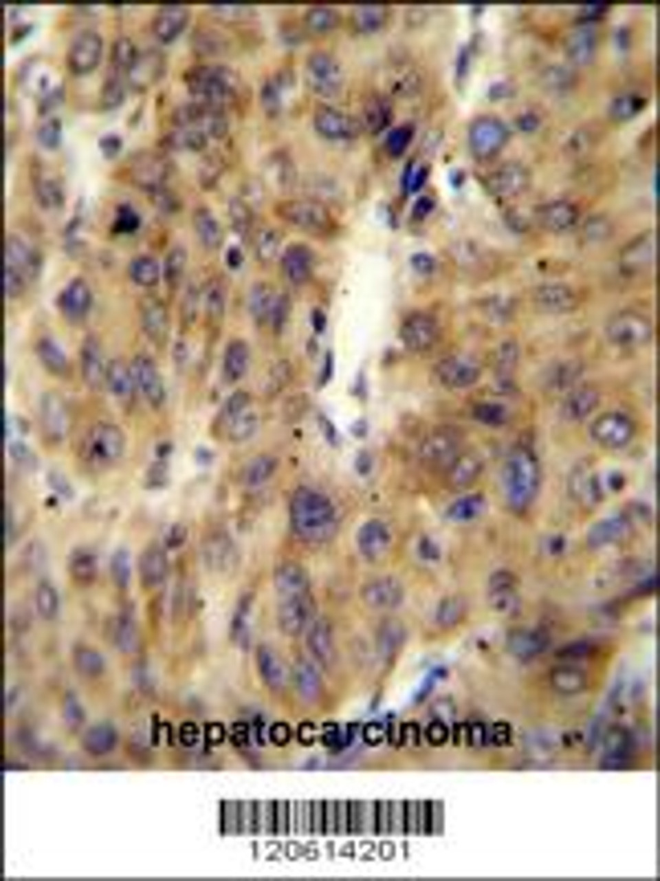 ACF Antibody immunohistochemistry analysis in formalin fixed and paraffin embedded human hepatocarcinoma followed by peroxidase conjugation of the secondary antibody and DAB staining.