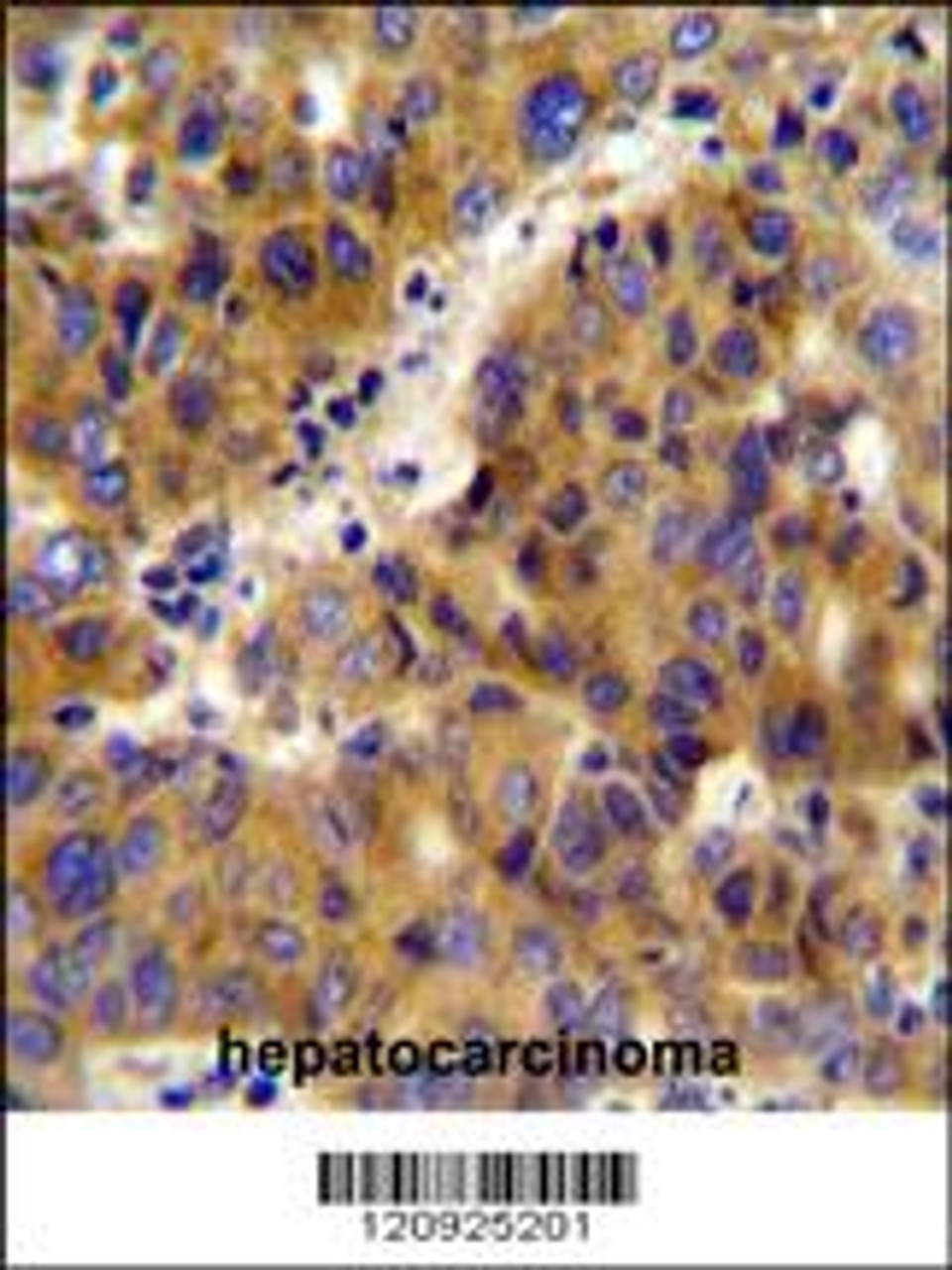 BCKDHB Antibody immunohistochemistry analysis in formalin fixed and paraffin embedded human hepatocarcinoma followed by peroxidase conjugation of the secondary antibody and DAB staining.