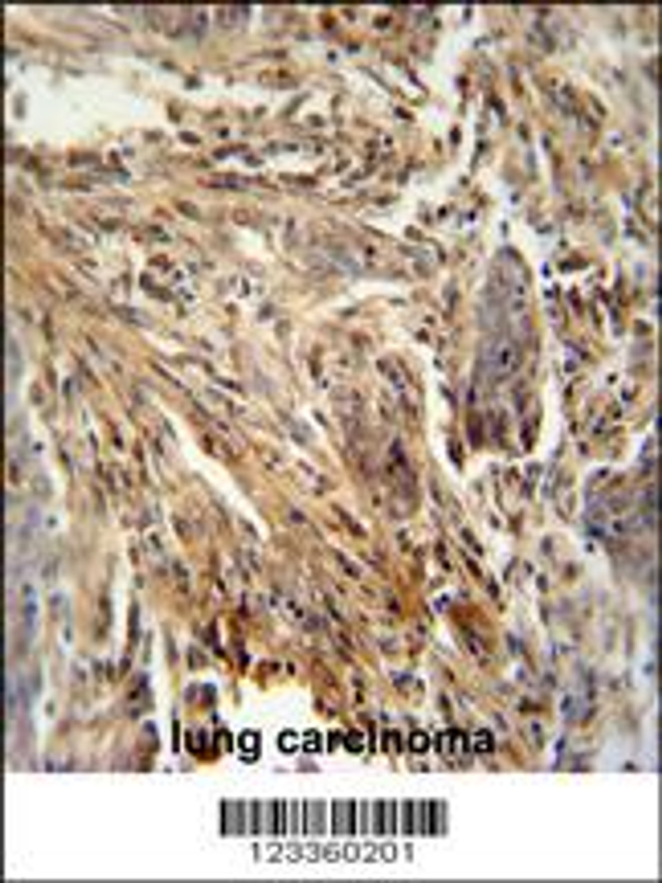 CSF2 antibody immunohistochemistry analysis in formalin fixed and paraffin embedded human lung carcinoma followed by peroxidase conjugation of the secondary antibody and DAB staining.