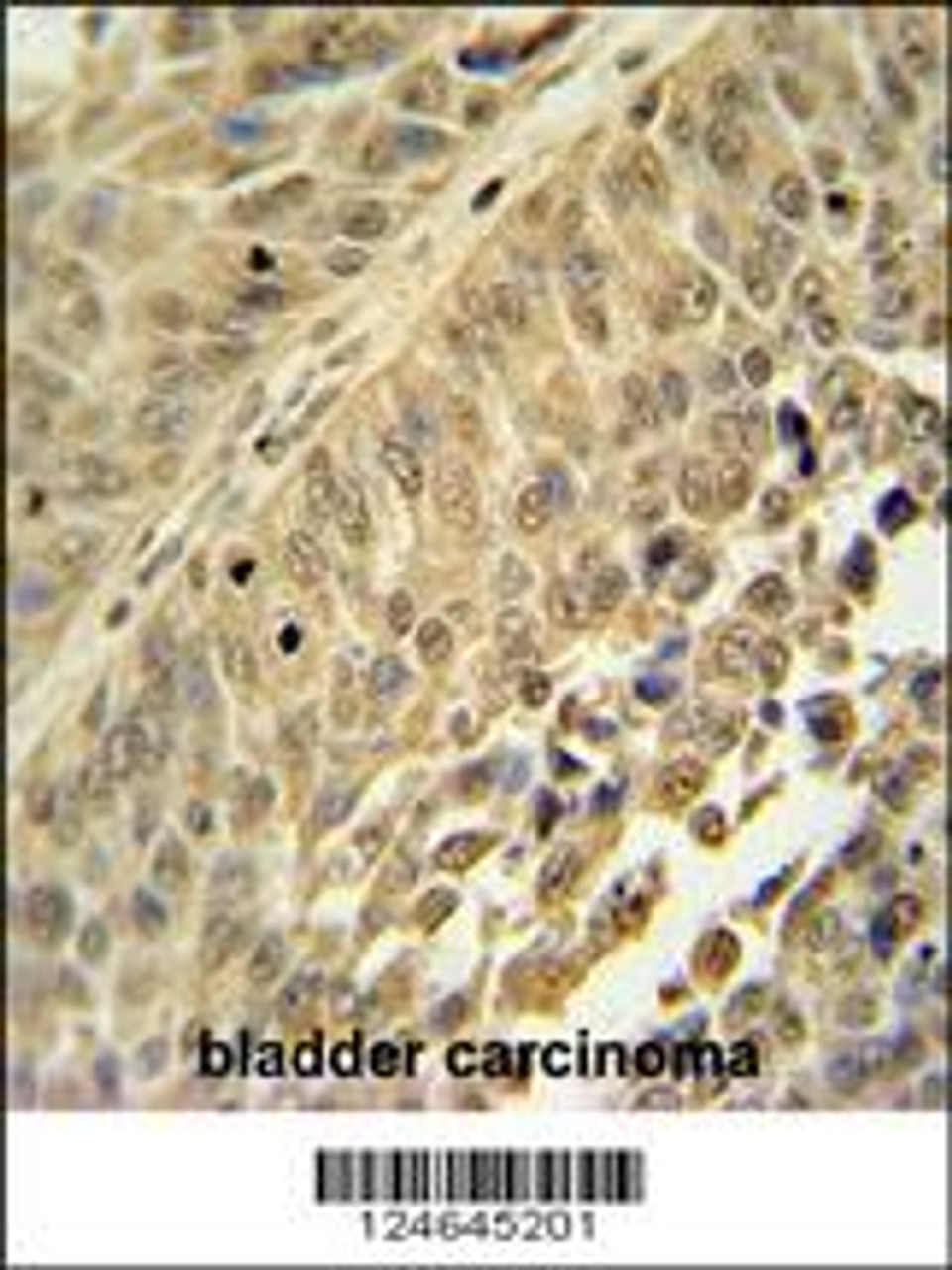 HNRNPC antibody immunohistochemistry analysis in formalin fixed and paraffin embedded human bladder carcinoma followed by peroxidase conjugation of the secondary antibody and DAB staining.