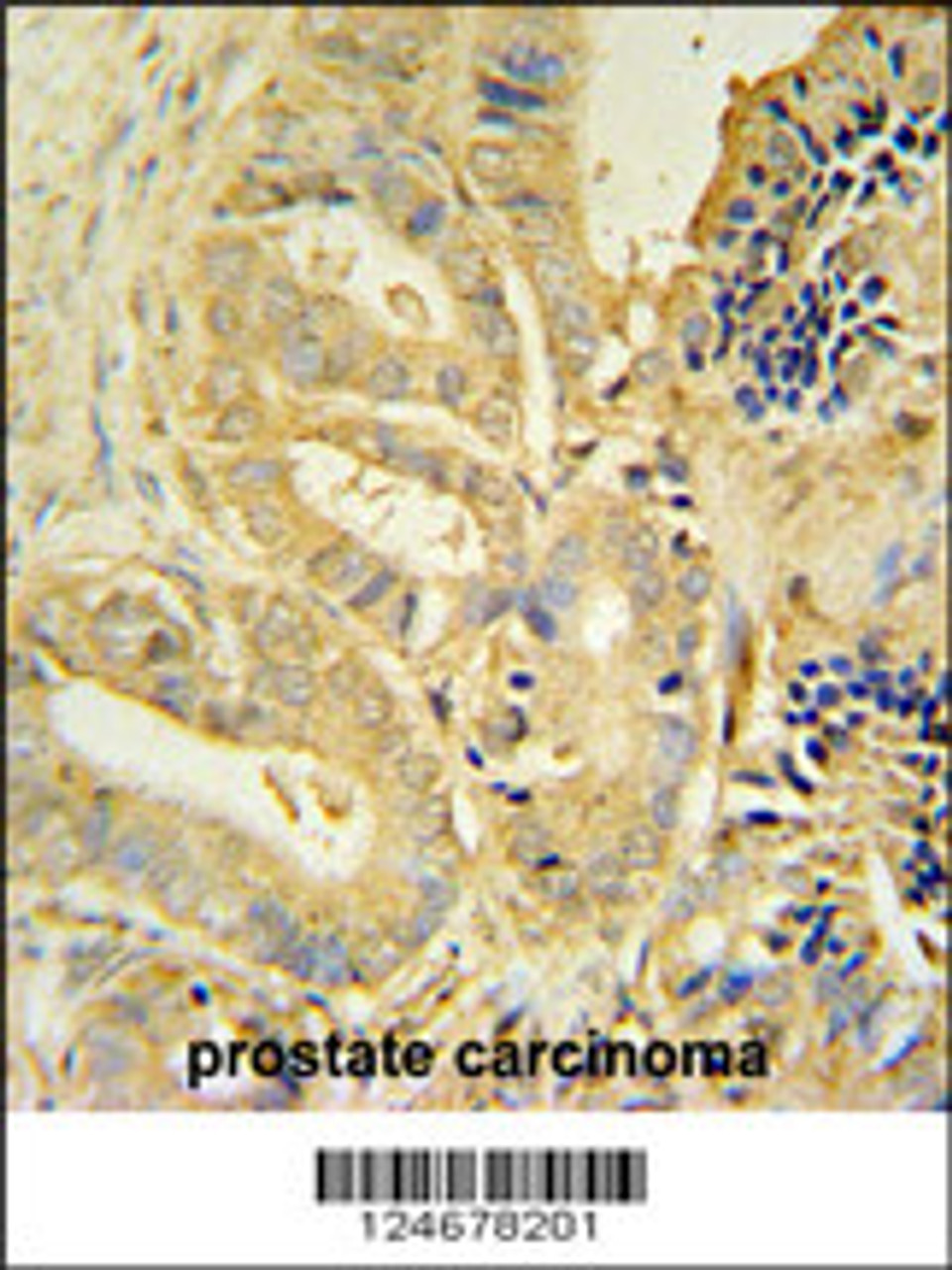 TLL1 antibody immunohistochemistry analysis in formalin fixed and paraffin embedded human prostate carcinoma followed by peroxidase conjugation of the secondary antibody and DAB staining.