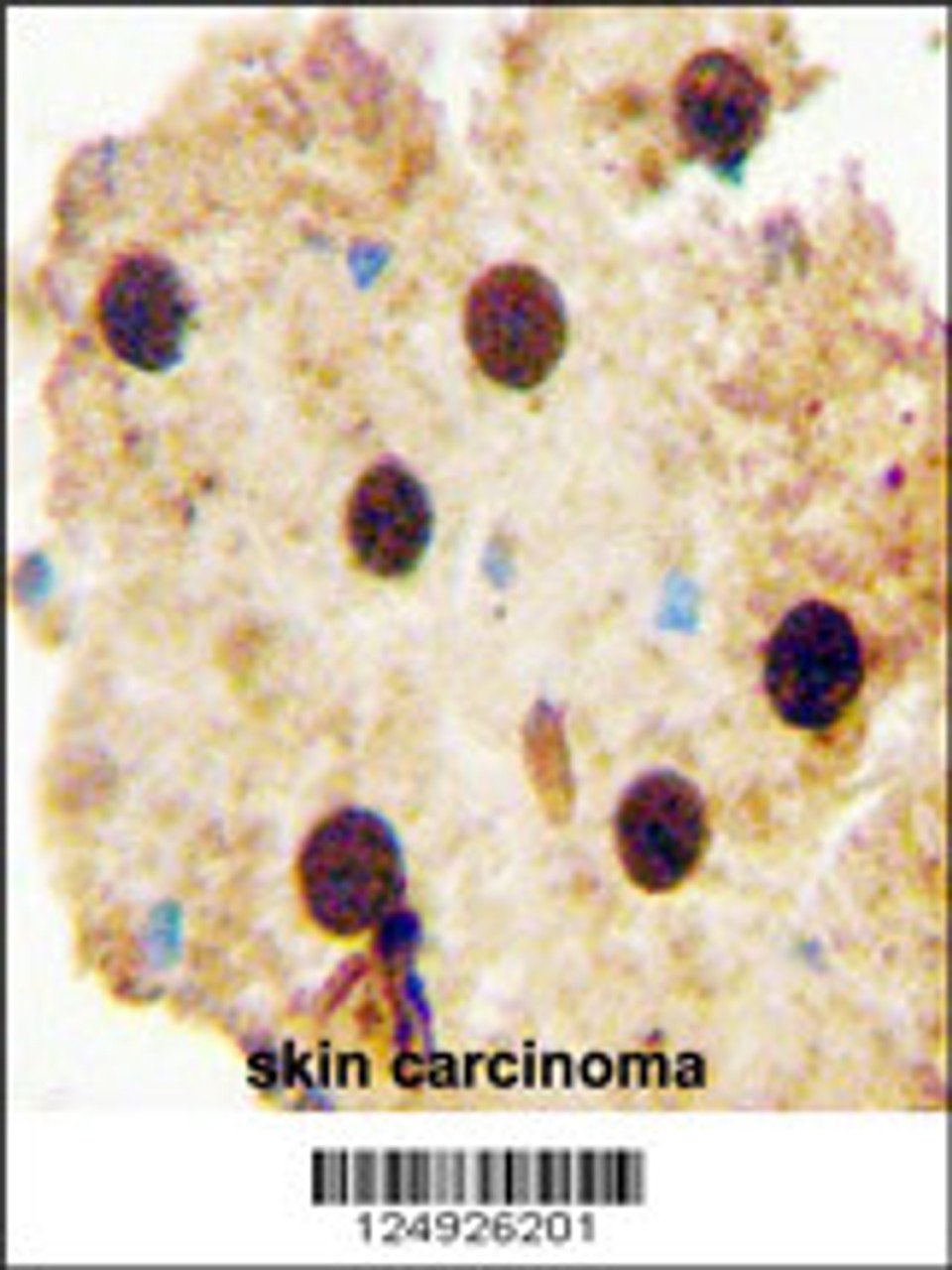 OAZ2 antibody immunohistochemistry analysis in formalin fixed and paraffin embedded human skin carcinoma followed by peroxidase conjugation of the secondary antibody and DAB staining.