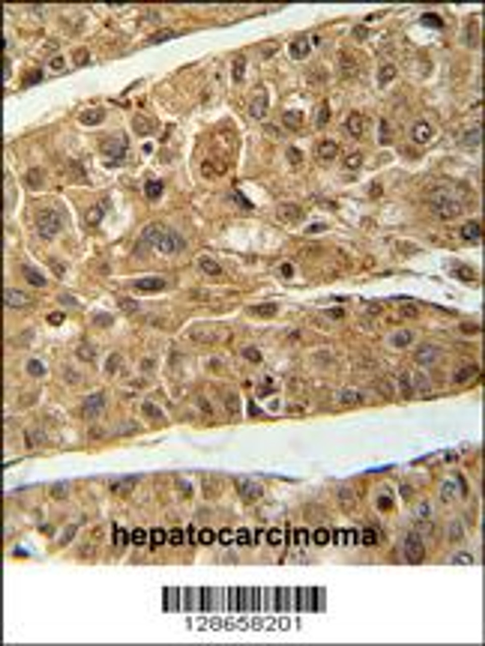 RT4I1 Antibody immunohistochemistry analysis in formalin fixed and paraffin embedded human hepatocarcinoma followed by peroxidase conjugation of the secondary antibody and DAB staining.