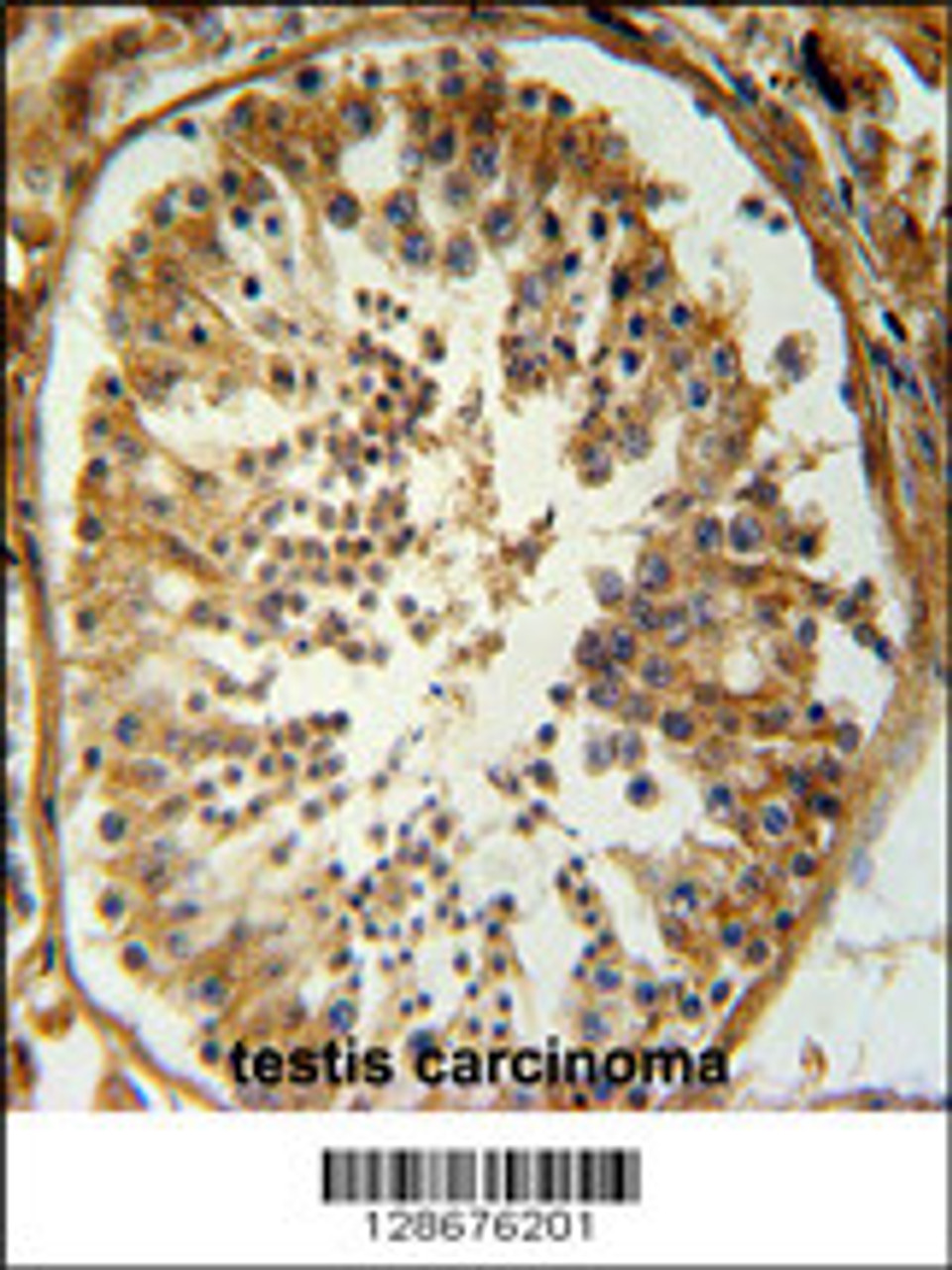 SRAC1 Antibody immunohistochemistry analysis in formalin fixed and paraffin embedded human testis carcinoma followed by peroxidase conjugation of the secondary antibody and DAB staining.