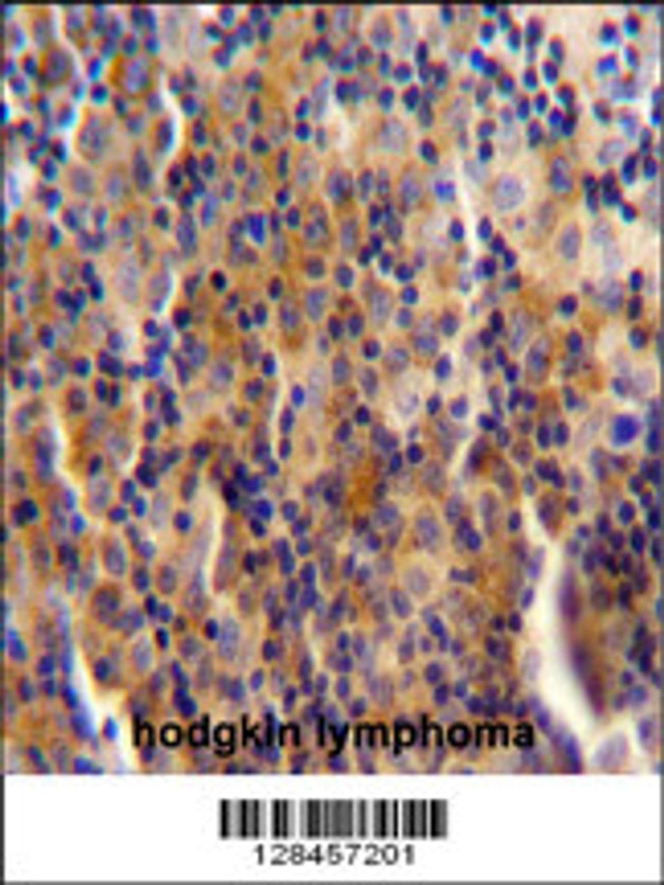 SYNE3 antibody immunohistochemistry analysis in formalin fixed and paraffin embedded human hodgkin lymphoma followed by peroxidase conjugation of the secondary antibody and DAB staining.