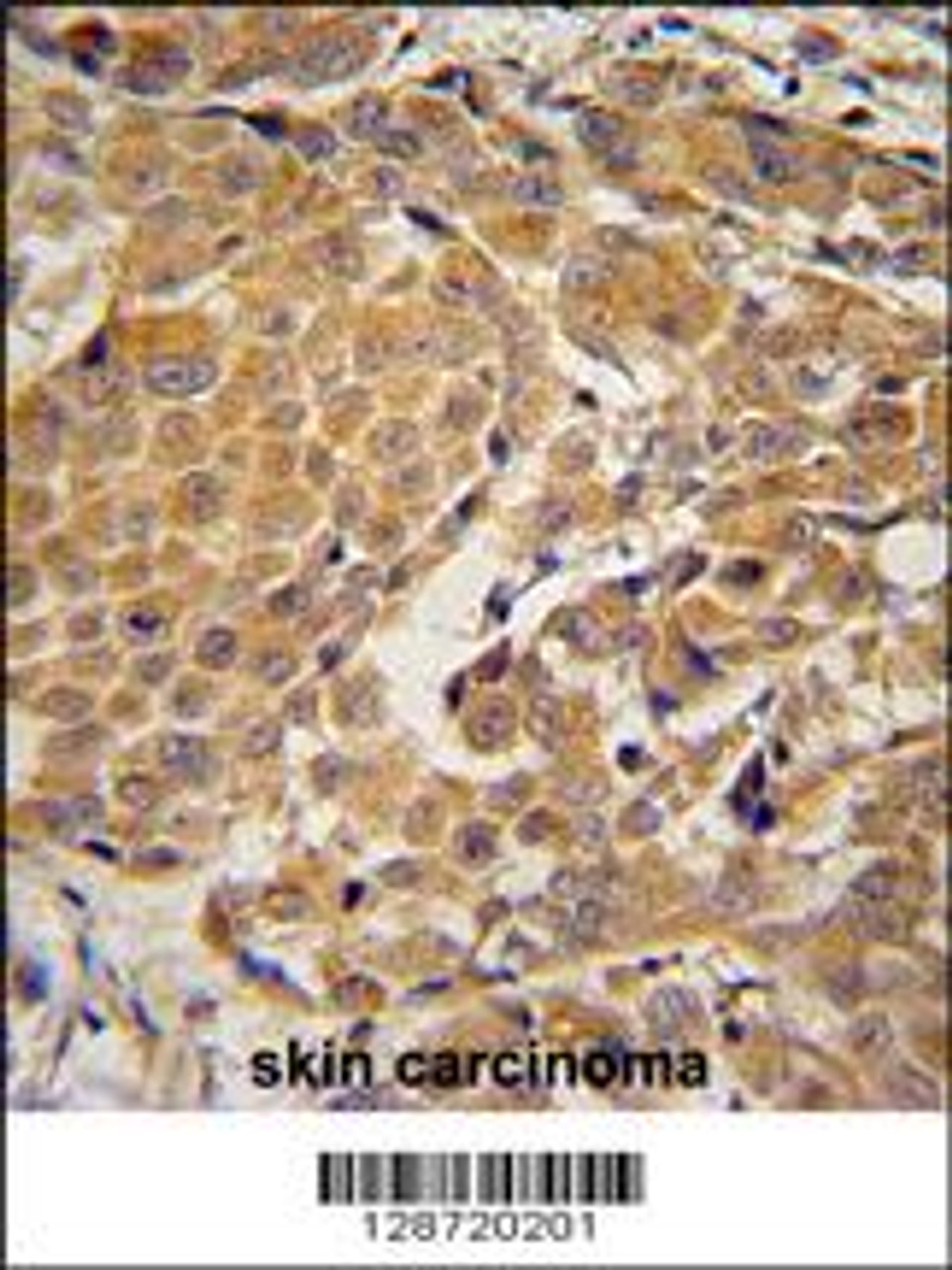 AWAT2 Antibody immunohistochemistry analysis in formalin fixed and paraffin embedded human skin carcinoma followed by peroxidase conjugation of the secondary antibody and DAB staining.