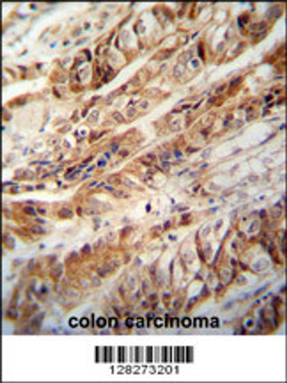 ZC3H15 antibody immunohistochemistry analysis in formalin fixed and paraffin embedded human colon carcinoma followed by peroxidase conjugation of the secondary antibody and DAB staining.