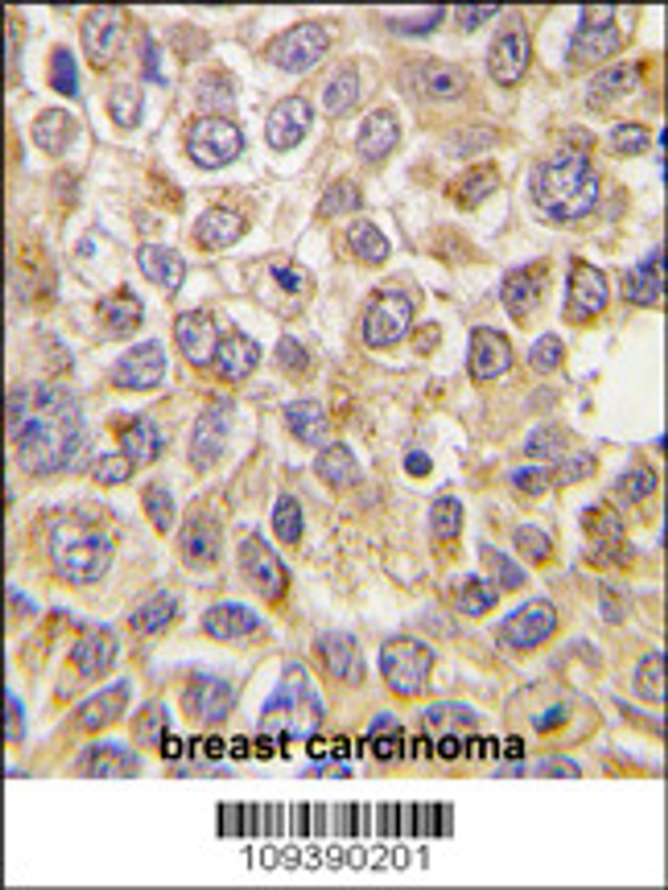 Formalin-fixed and paraffin-embedded human breast carcinoma tissue reacted with PMAT (Slc29a4) Antibody, which was peroxidase-conjugated to the secondary antibody, followed by DAB staining.