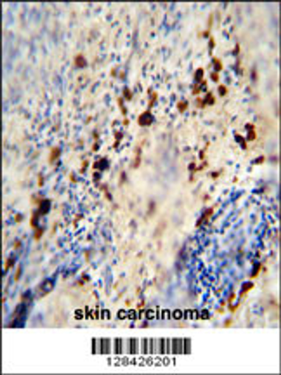 LCE1A antibody immunohistochemistry analysis in formalin fixed and paraffin embedded human skin carcinoma followed by peroxidase conjugation of the secondary antibody and DAB staining.