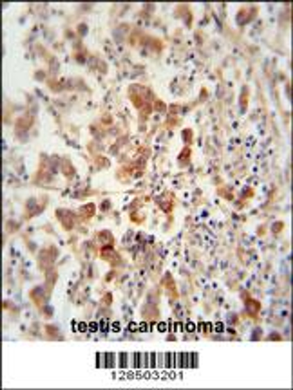 TEX13B antibody immunohistochemistry analysis in formalin fixed and paraffin embedded human testis carcinoma followed by peroxidase conjugation of the secondary antibody and DAB staining.