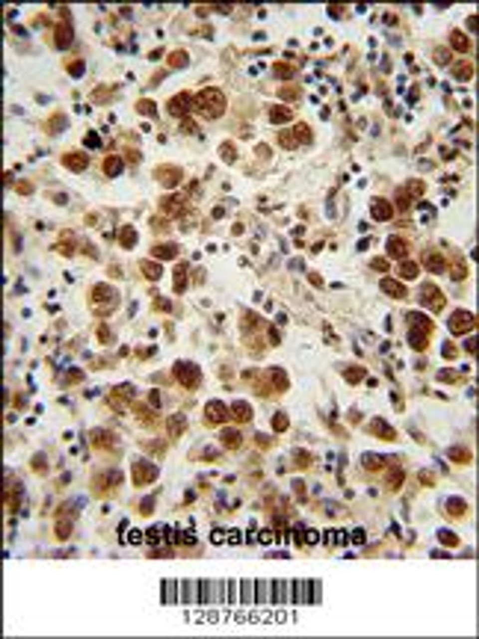 SOHLH1 Antibody immunohistochemistry analysis in formalin fixed and paraffin embedded human testis carcinoma followed by peroxidase conjugation of the secondary antibody and DAB staining.
