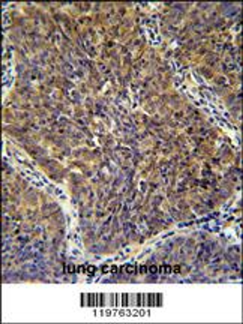 CD2BP2 antibodyimmunohistochemistry analysis in formalin fixed and paraffin embedded human lung carcinoma followed by peroxidase conjugation of the secondary antibody and DAB staining. This data demonstrates the use of the CD2BP2 antibodyfor immunohistochemistry.