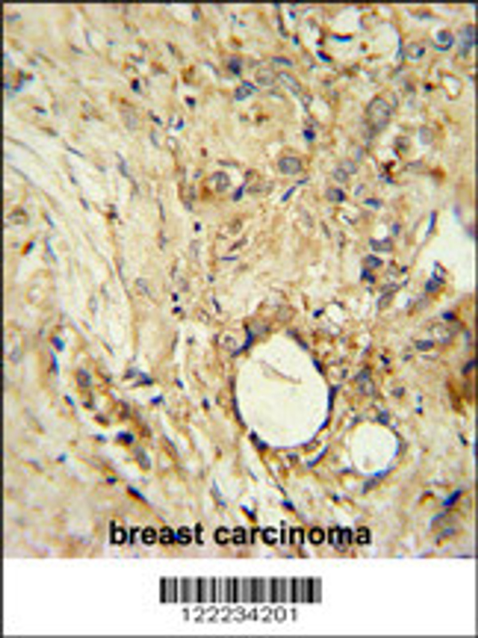 ITIH5 Antibody immunohistochemistry analysis in formalin fixed and paraffin embedded human breast carcinoma followed by peroxidase conjugation of the secondary antibody and DAB staining.