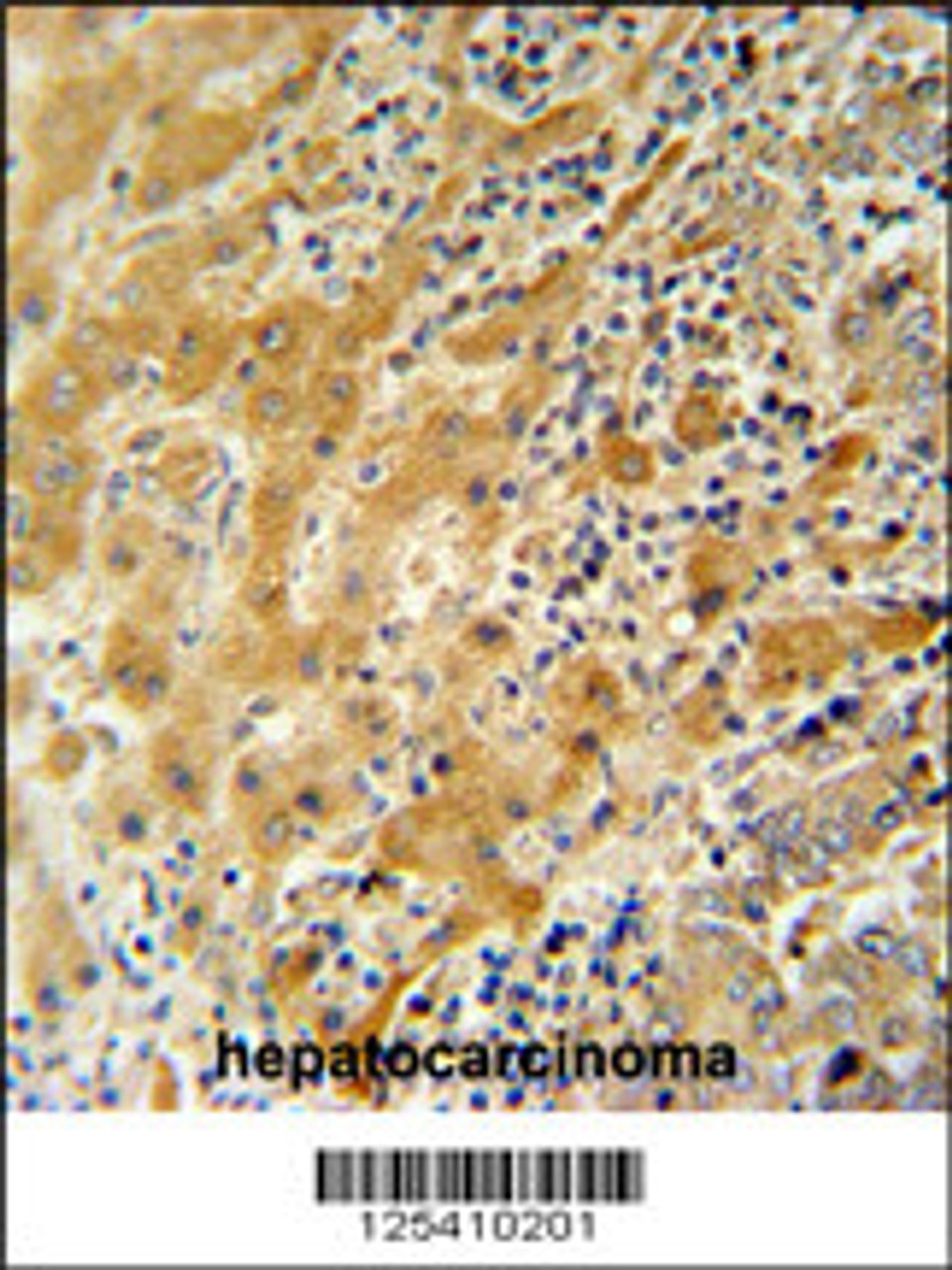NUSAP antibody immunohistochemistry analysis in formalin fixed and paraffin embedded human hepatocarcinoma followed by peroxidase conjugation of the secondary antibody and DAB staining.